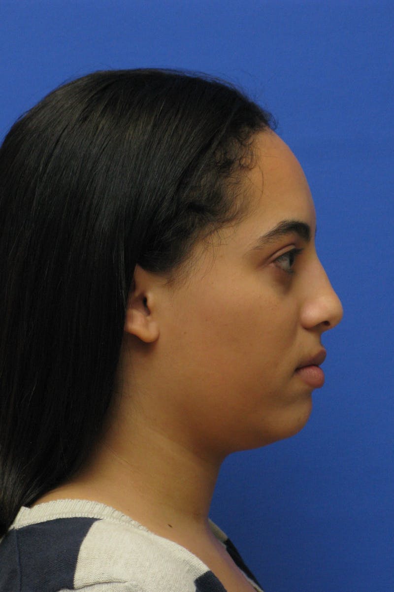 Nonsurgical Rhinoplasty Before & After Gallery - Patient 127902 - Image 3