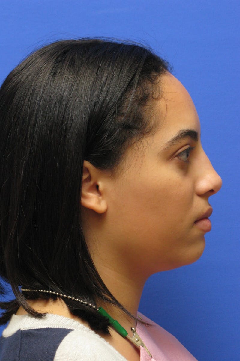 Nonsurgical Rhinoplasty Before & After Gallery - Patient 127902 - Image 4