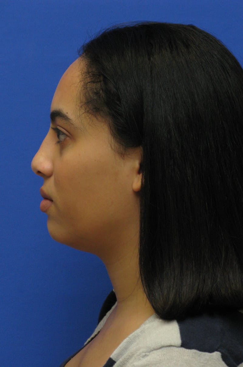 Nonsurgical Rhinoplasty Before & After Gallery - Patient 127902 - Image 5