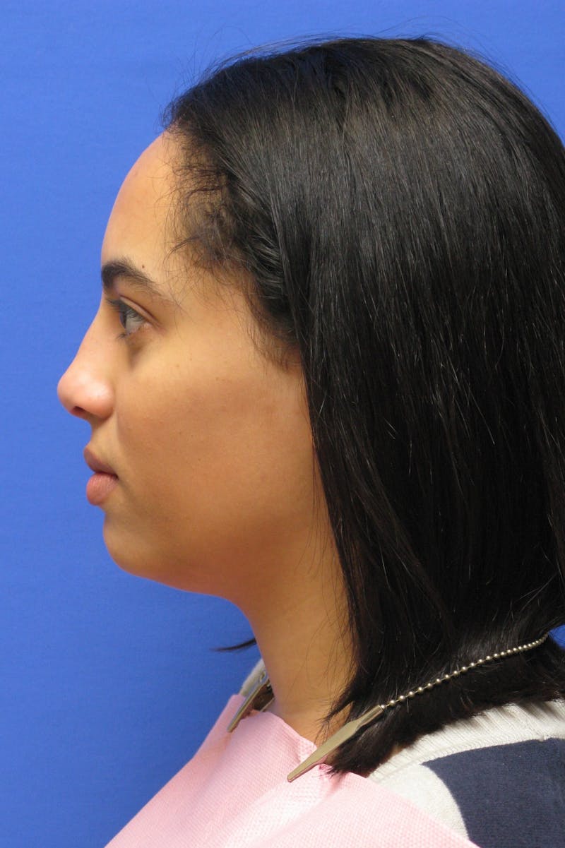 Nonsurgical Rhinoplasty Before & After Gallery - Patient 127902 - Image 6