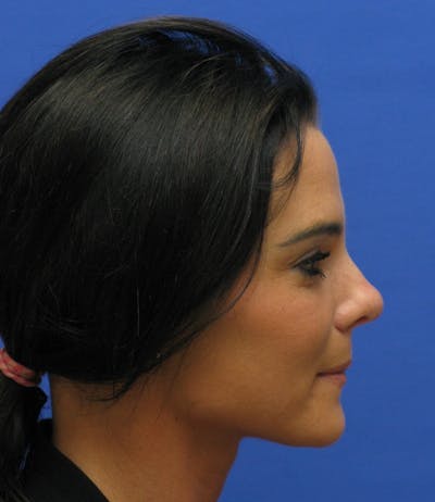 Nonsurgical Rhinoplasty Before & After Gallery - Patient 250753 - Image 1