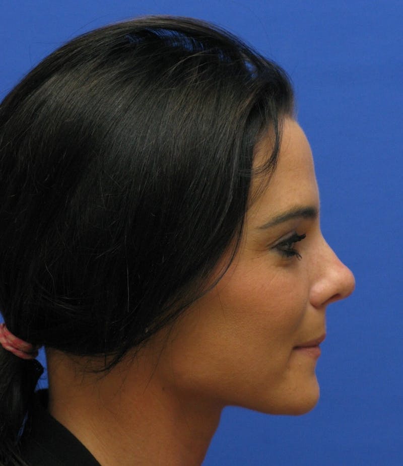 Nonsurgical Rhinoplasty Before & After Gallery - Patient 250753 - Image 1