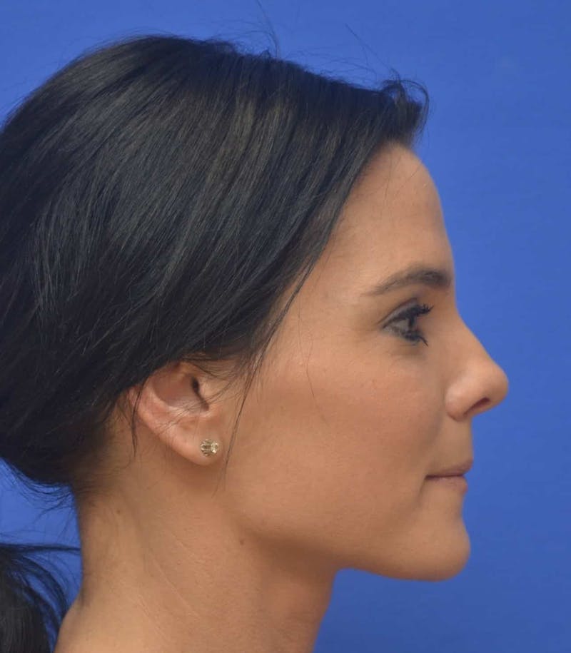 Nonsurgical Rhinoplasty Before & After Gallery - Patient 250753 - Image 2