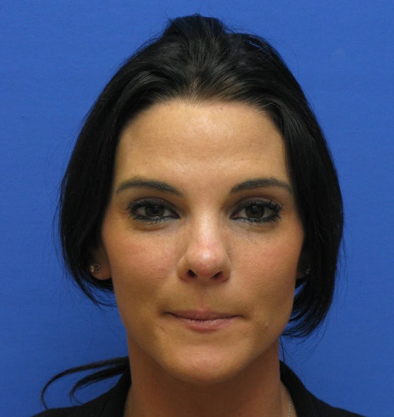Nonsurgical Rhinoplasty Before & After Gallery - Patient 250753 - Image 3