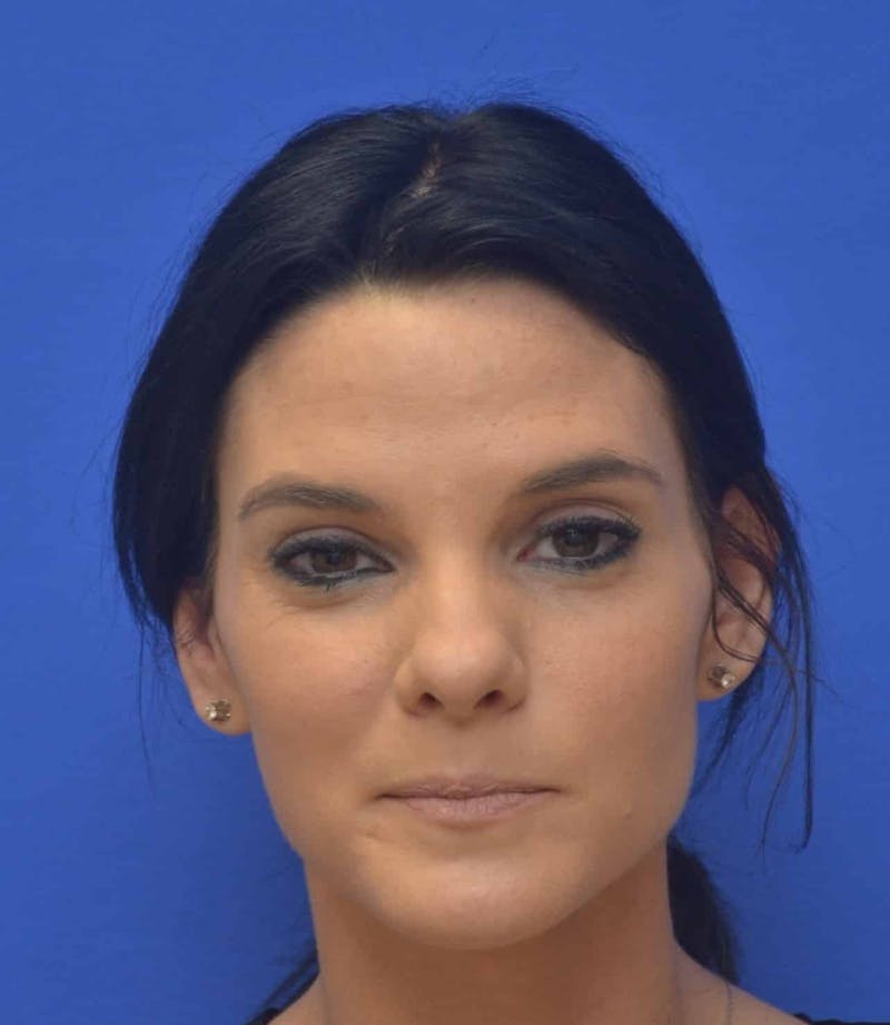 Nonsurgical Rhinoplasty Before & After Gallery - Patient 250753 - Image 4