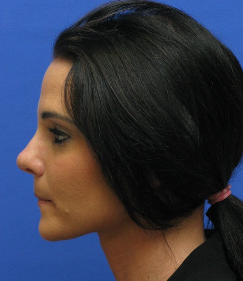 Nonsurgical Rhinoplasty Before & After Gallery - Patient 250753 - Image 5
