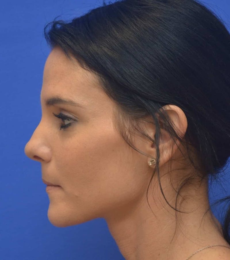 Nonsurgical Rhinoplasty Before & After Gallery - Patient 250753 - Image 6