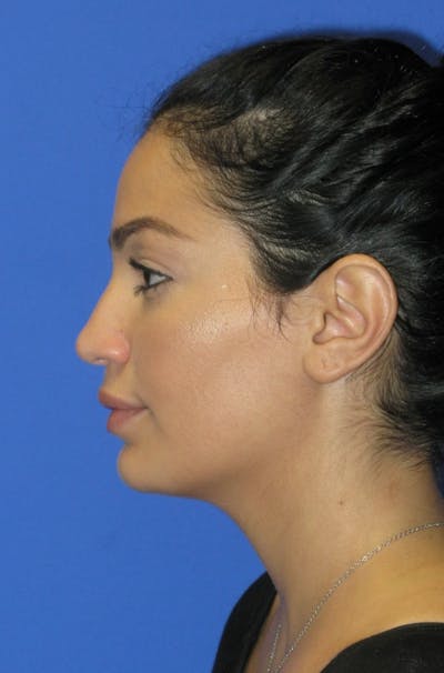 Nonsurgical Rhinoplasty Before & After Gallery - Patient 369863 - Image 1