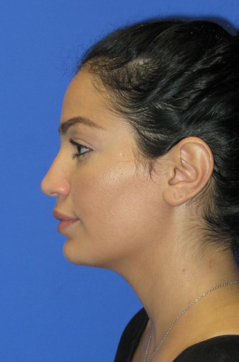 Nonsurgical Rhinoplasty Before & After Gallery - Patient 369863 - Image 1