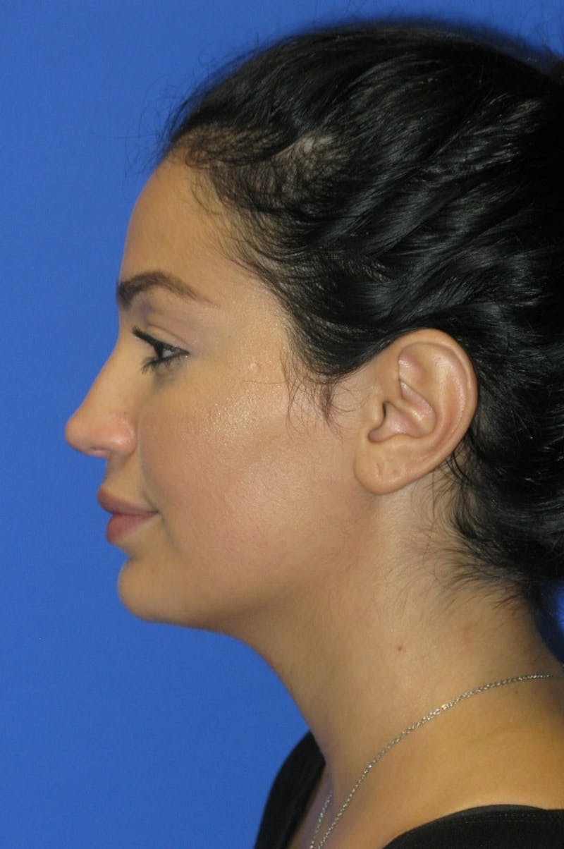 Nonsurgical Rhinoplasty Before & After Gallery - Patient 369863 - Image 2