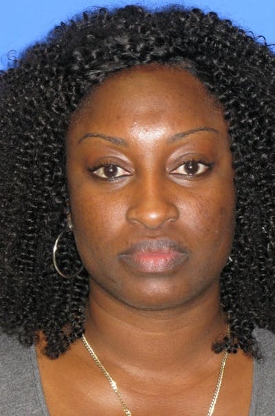 Nonsurgical Rhinoplasty Before & After Gallery - Patient 343009 - Image 1