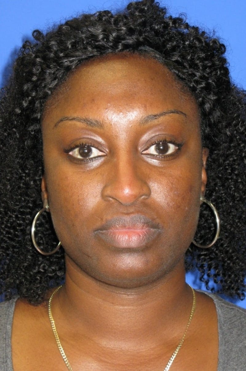 Nonsurgical Rhinoplasty Before & After Gallery - Patient 343009 - Image 2