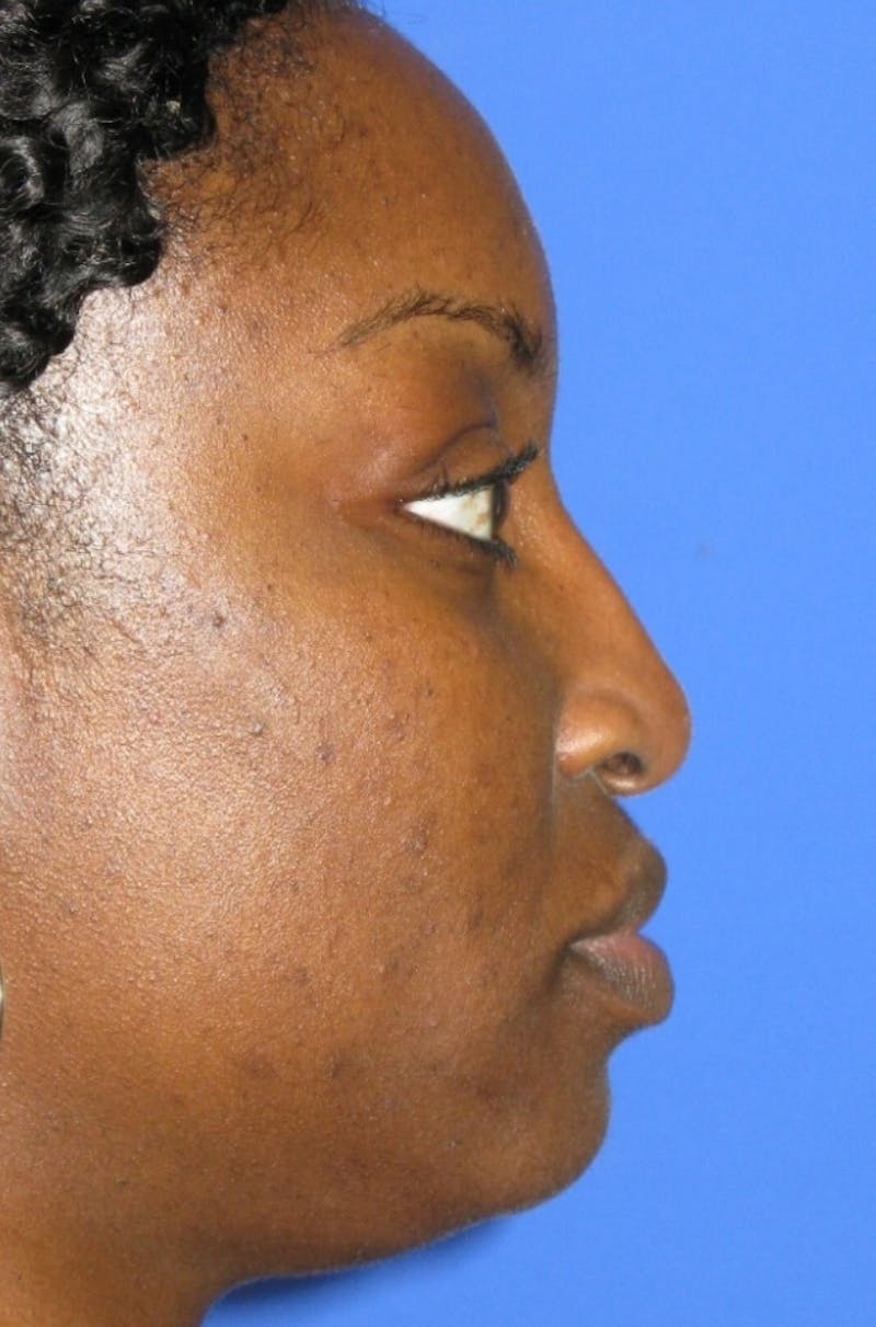 Nonsurgical Rhinoplasty Before & After Gallery - Patient 343009 - Image 4