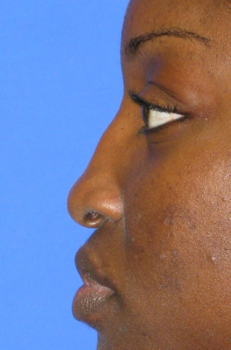 Nonsurgical Rhinoplasty Before & After Gallery - Patient 343009 - Image 5