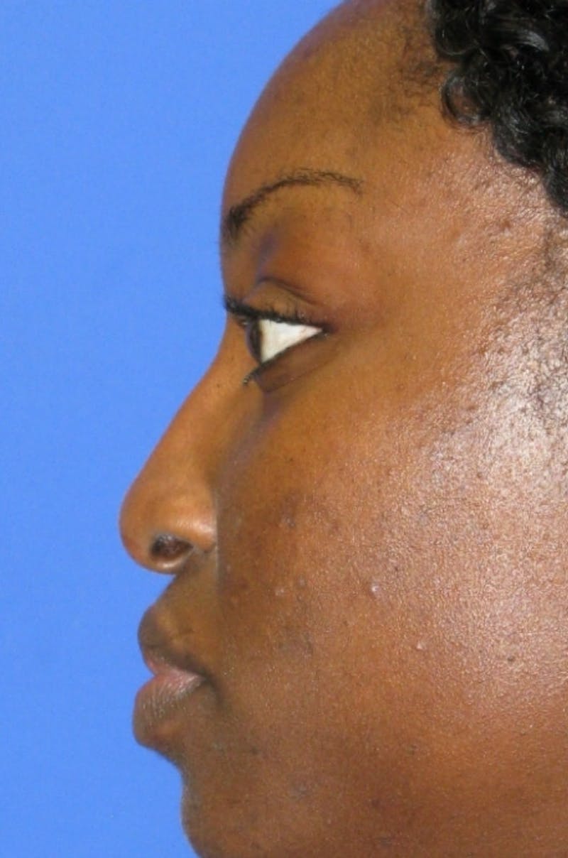 Nonsurgical Rhinoplasty Before & After Gallery - Patient 343009 - Image 6