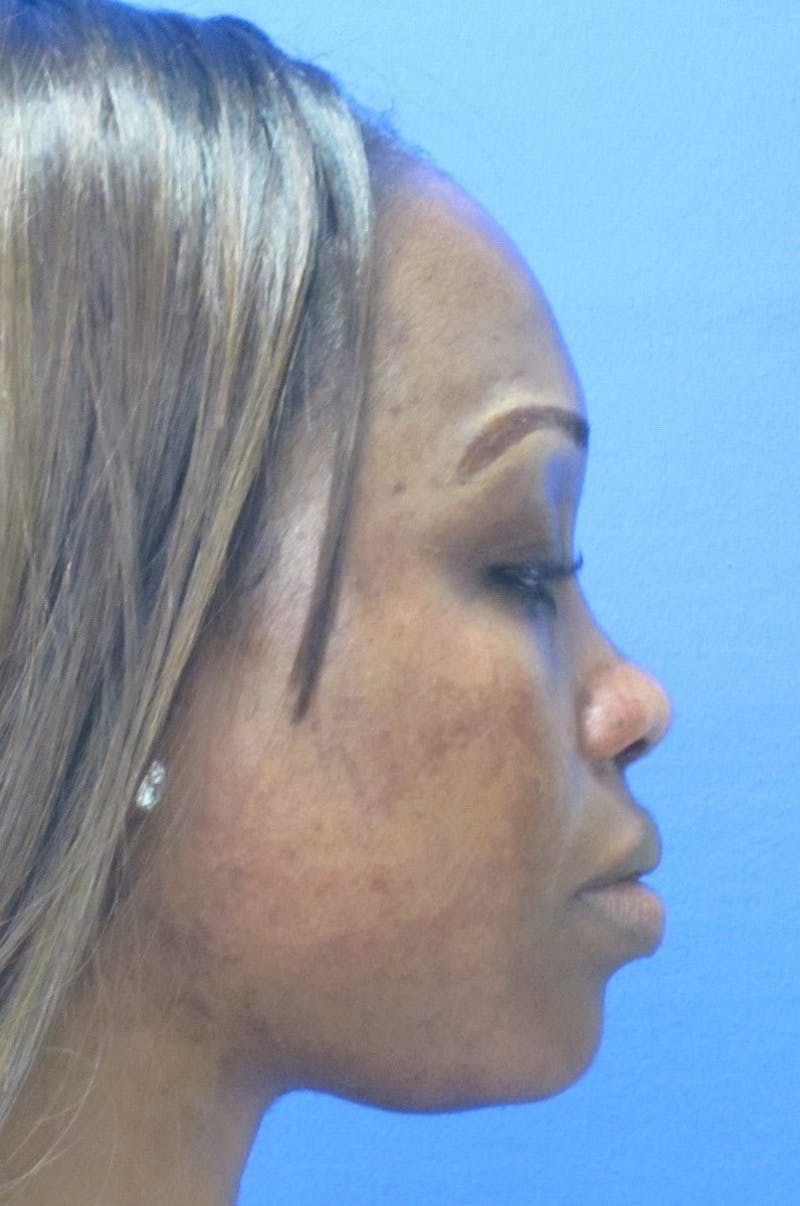 Nonsurgical Rhinoplasty Before & After Gallery - Patient 386706 - Image 1