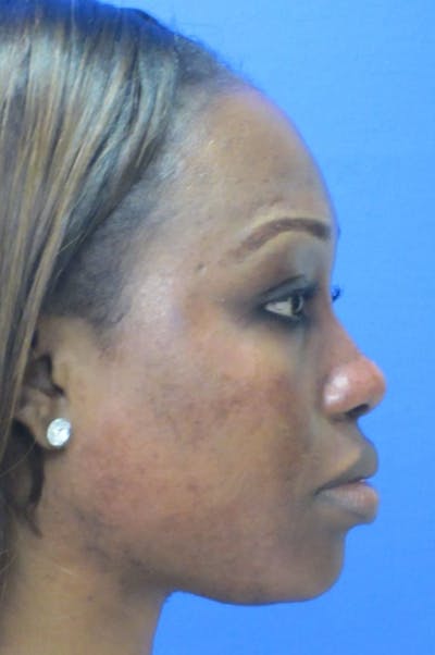 Nonsurgical Rhinoplasty Before & After Gallery - Patient 386706 - Image 2