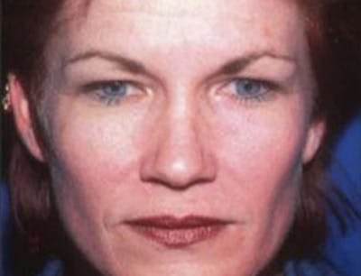 Brow Lift Before & After Gallery - Patient 311781 - Image 1