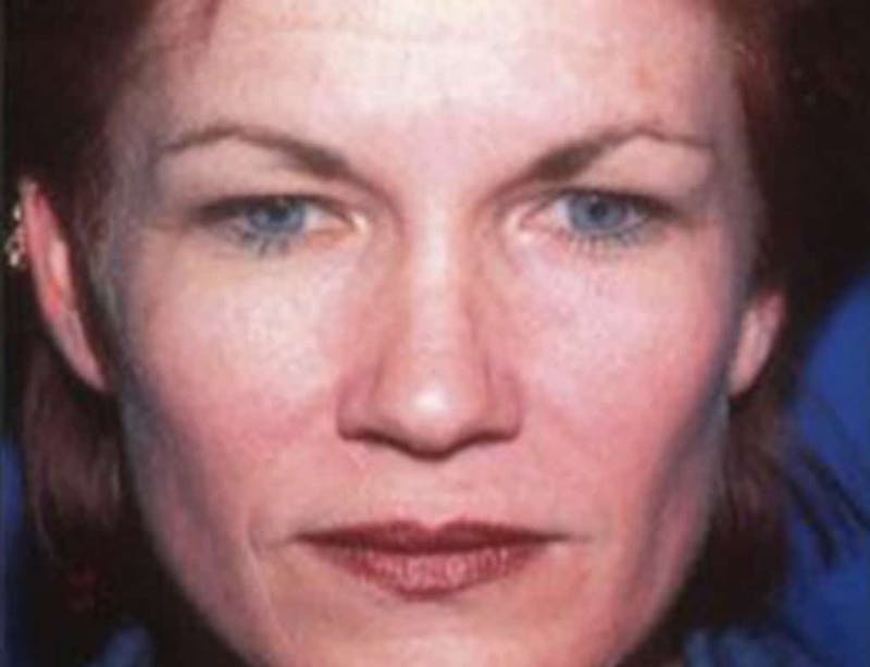 Brow Lift Before & After Gallery - Patient 311781 - Image 1