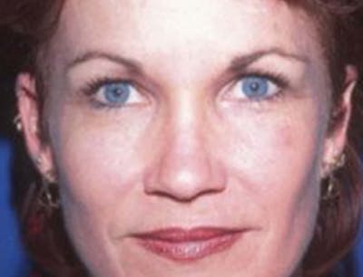 Brow Lift Before & After Gallery - Patient 311781 - Image 2
