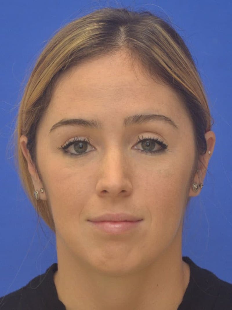 Chin Implant Before & After Gallery - Patient 267914 - Image 1
