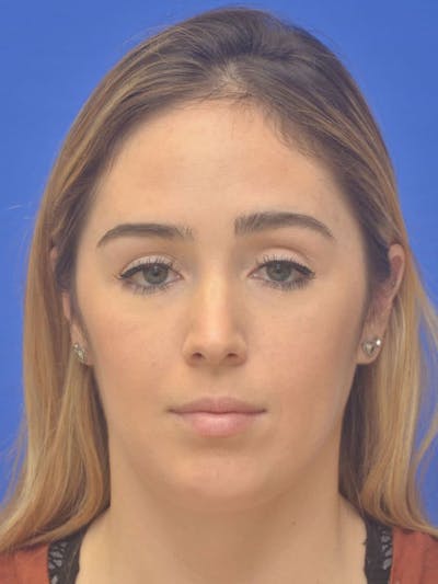 Chin Implant Before & After Gallery - Patient 267914 - Image 2