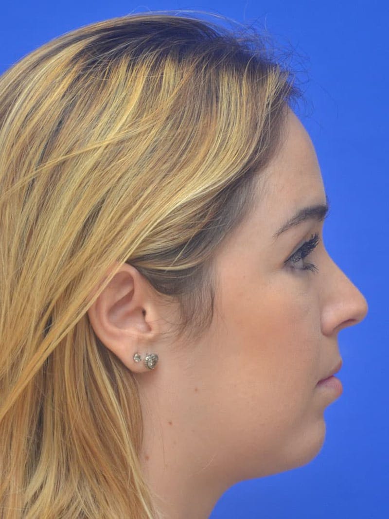 Chin Implant Before & After Gallery - Patient 267914 - Image 4