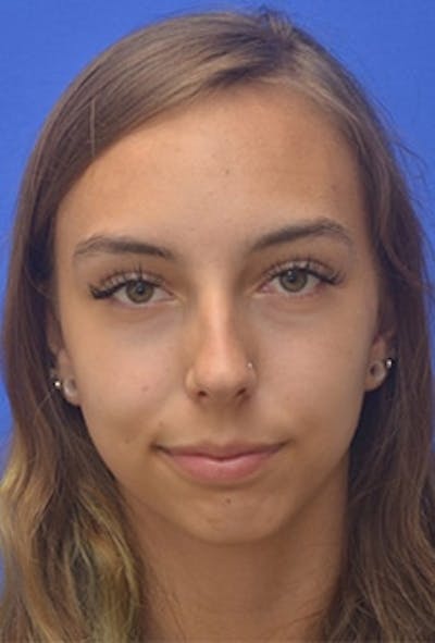 Chin Implant Before & After Gallery - Patient 465693 - Image 1