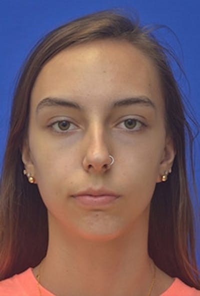 Chin Implant Before & After Gallery - Patient 465693 - Image 2