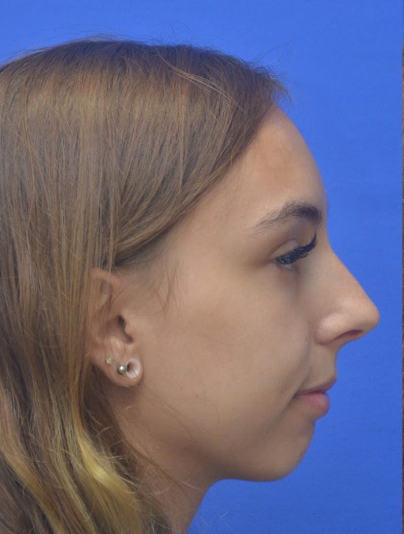 Chin Implant Before & After Gallery - Patient 465693 - Image 3