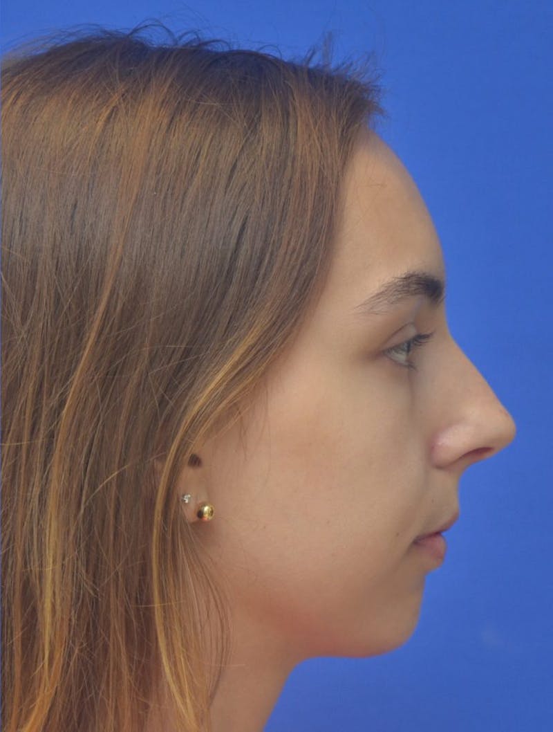 Chin Implant Before & After Gallery - Patient 465693 - Image 4