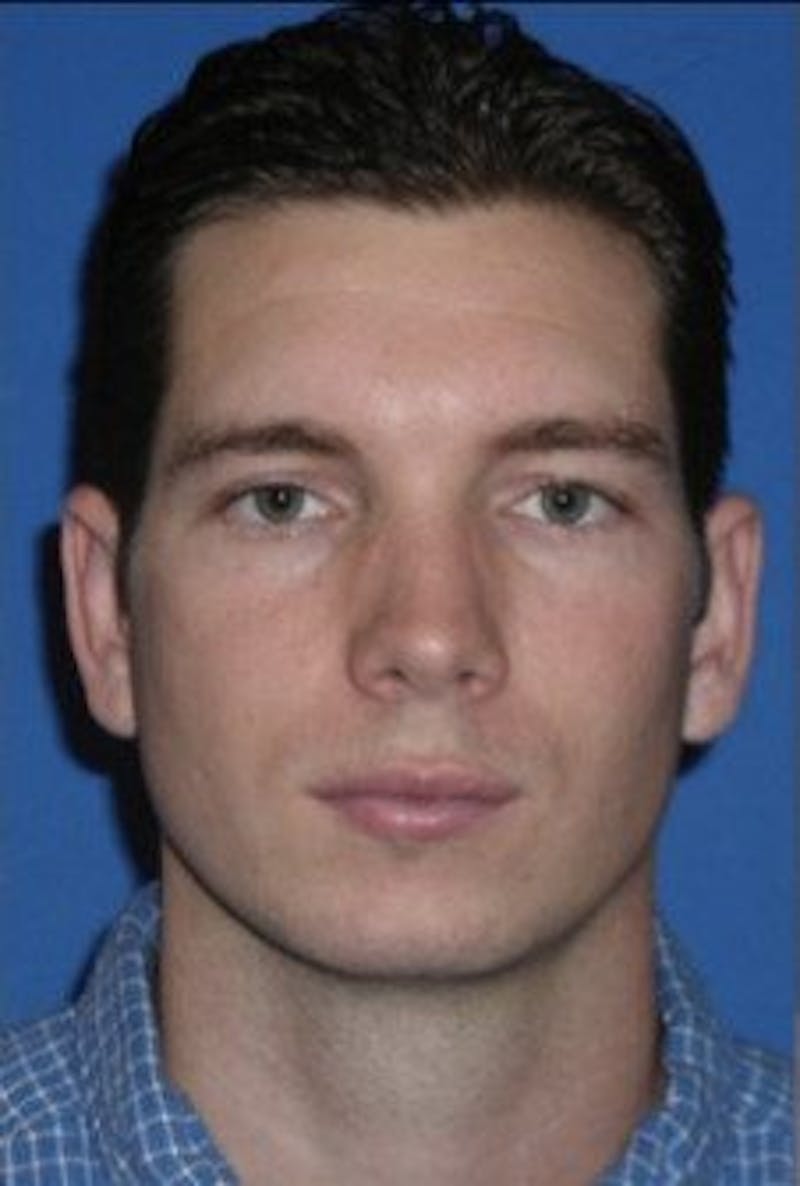 Chin Implant Before & After Gallery - Patient 236760 - Image 1
