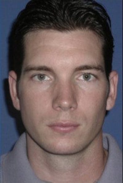 Chin Implant Before & After Gallery - Patient 236760 - Image 2
