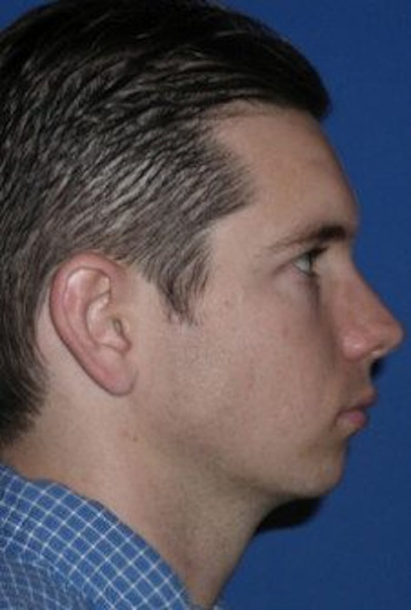 Chin Implant Before & After Gallery - Patient 236760 - Image 3