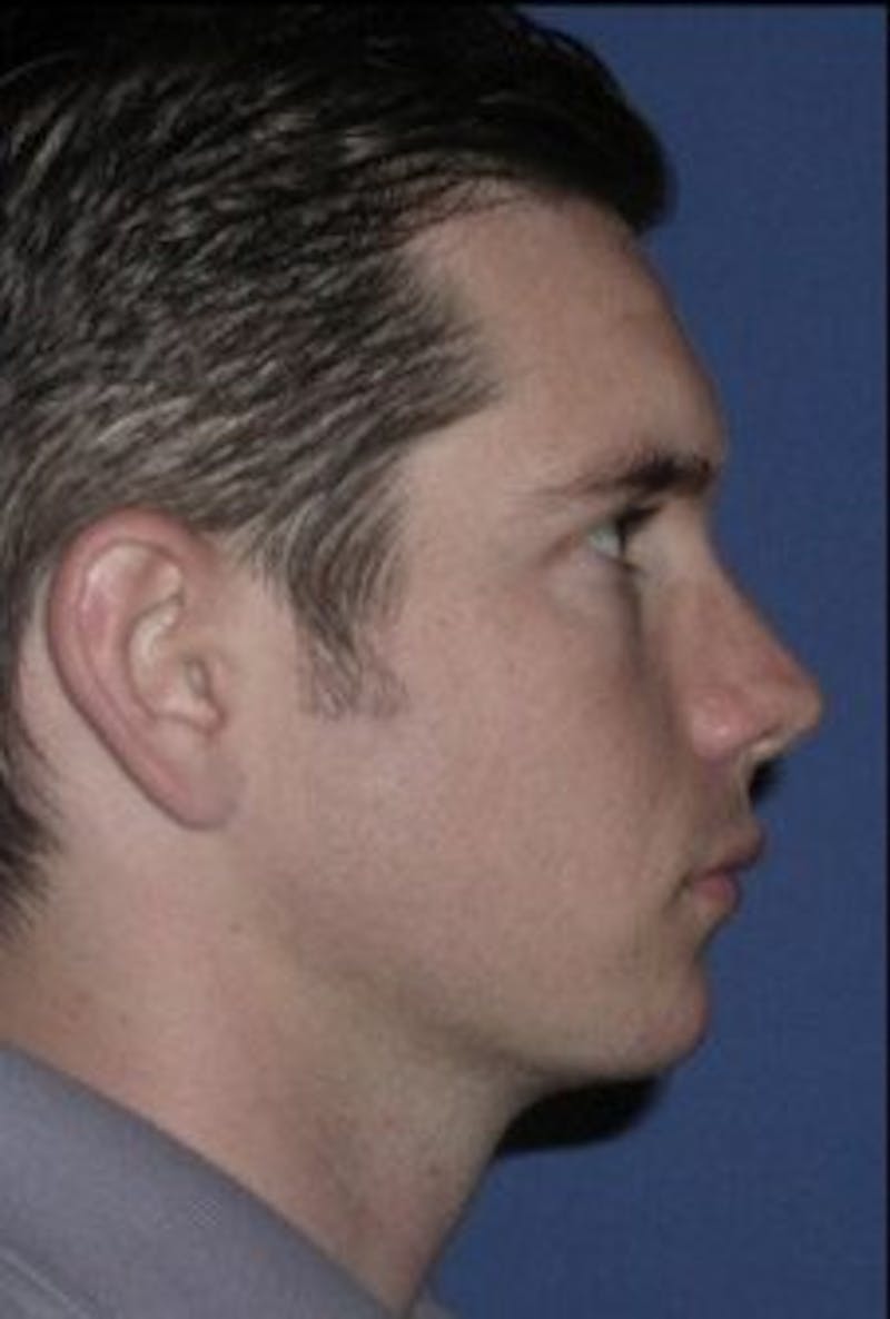 Chin Implant Before & After Gallery - Patient 236760 - Image 4