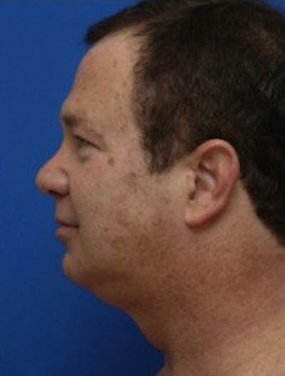 Neck Liposuction Before & After Gallery - Patient 966199 - Image 1