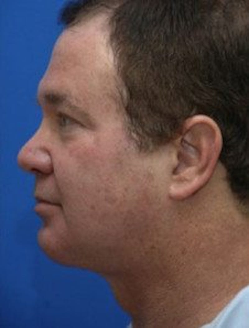 Neck Liposuction Before & After Gallery - Patient 966199 - Image 2