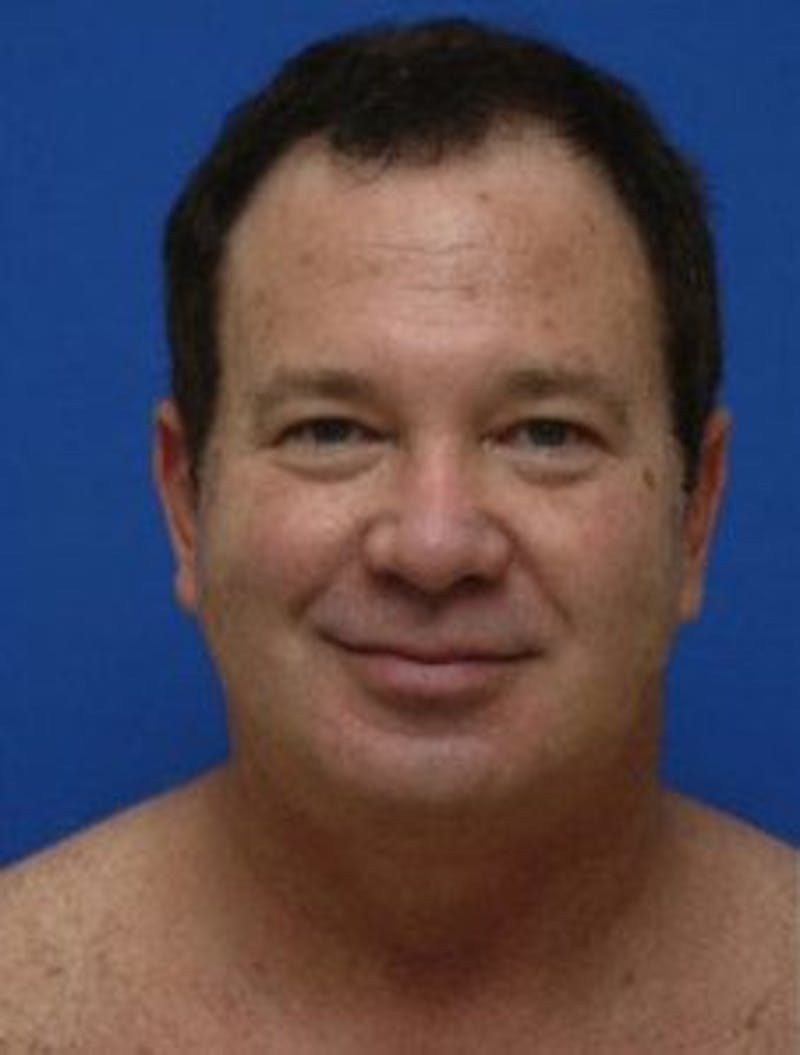Neck Liposuction Before & After Gallery - Patient 966199 - Image 3