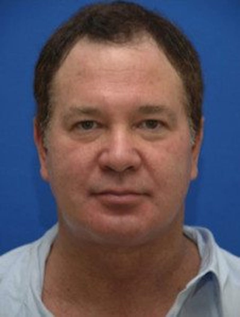 Neck Liposuction Before & After Gallery - Patient 966199 - Image 4