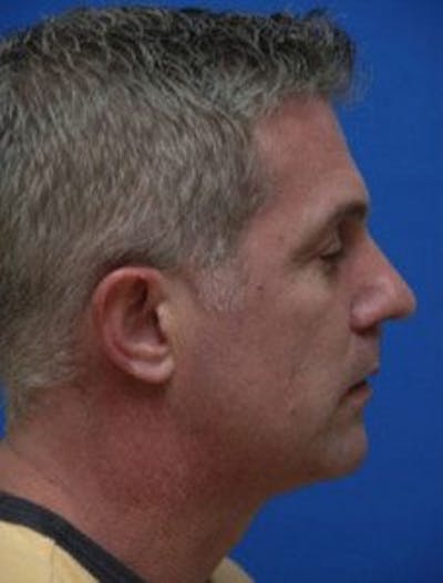 Neck Liposuction Before & After Gallery - Patient 342443 - Image 1