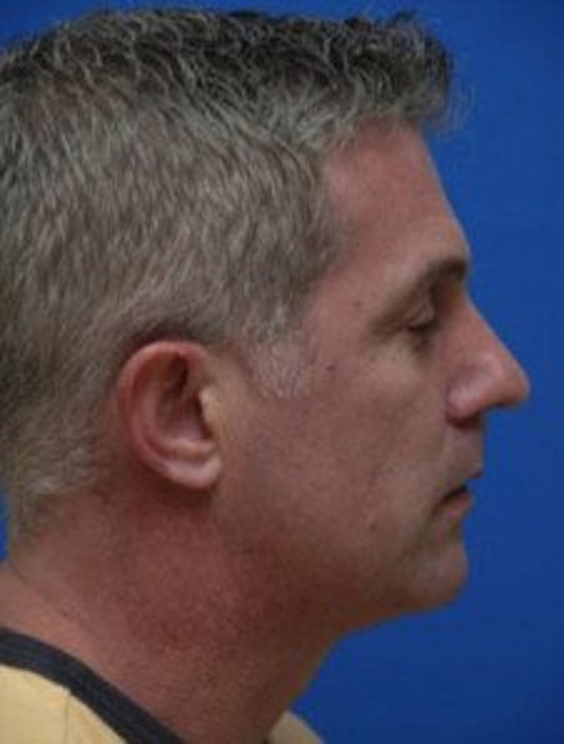 Chin Implant Before & After Gallery - Patient 412821 - Image 1
