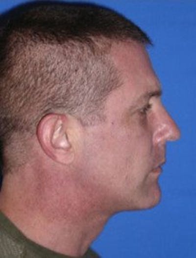 Neck Liposuction Before & After Gallery - Patient 342443 - Image 2