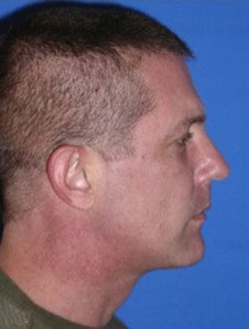 Chin Implant Before & After Gallery - Patient 412821 - Image 2