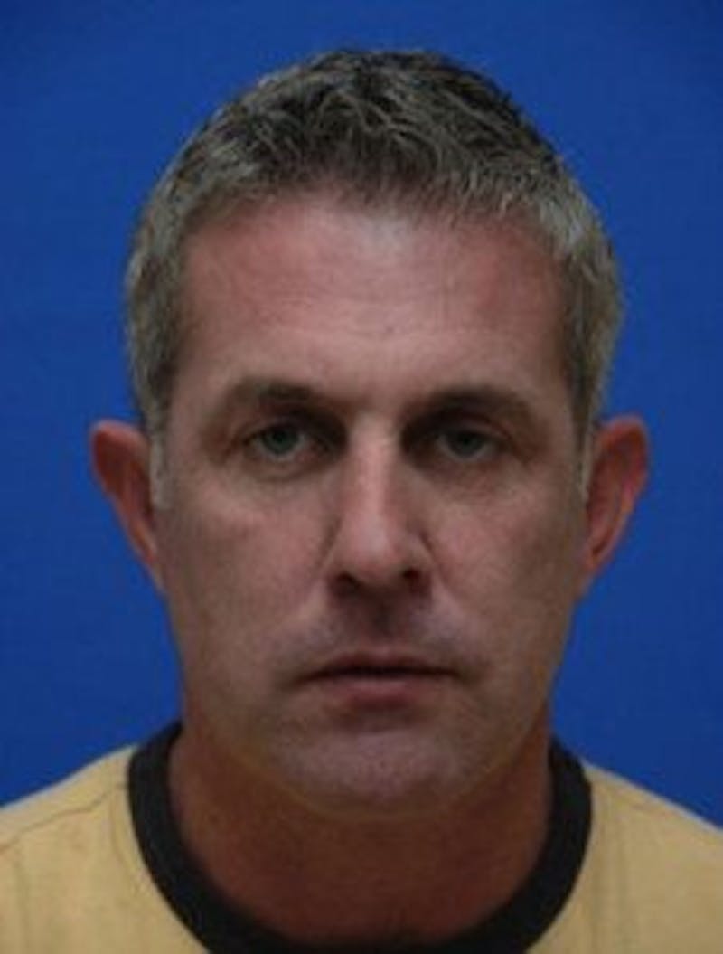 Chin Implant Before & After Gallery - Patient 412821 - Image 3