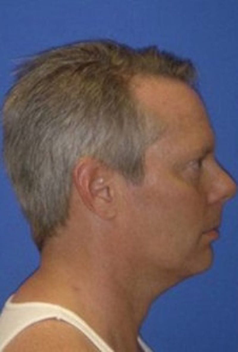Chin Implant Before & After Gallery - Patient 160494 - Image 1