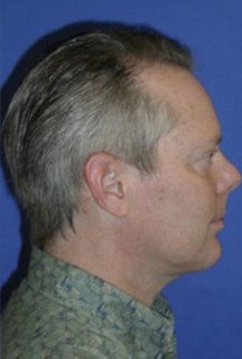 Chin Implant Before & After Gallery - Patient 160494 - Image 2