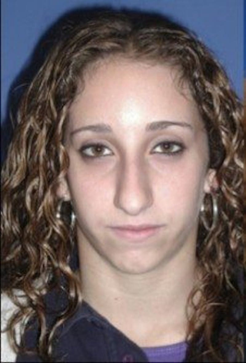 Chin Implant Before & After Gallery - Patient 286367 - Image 1