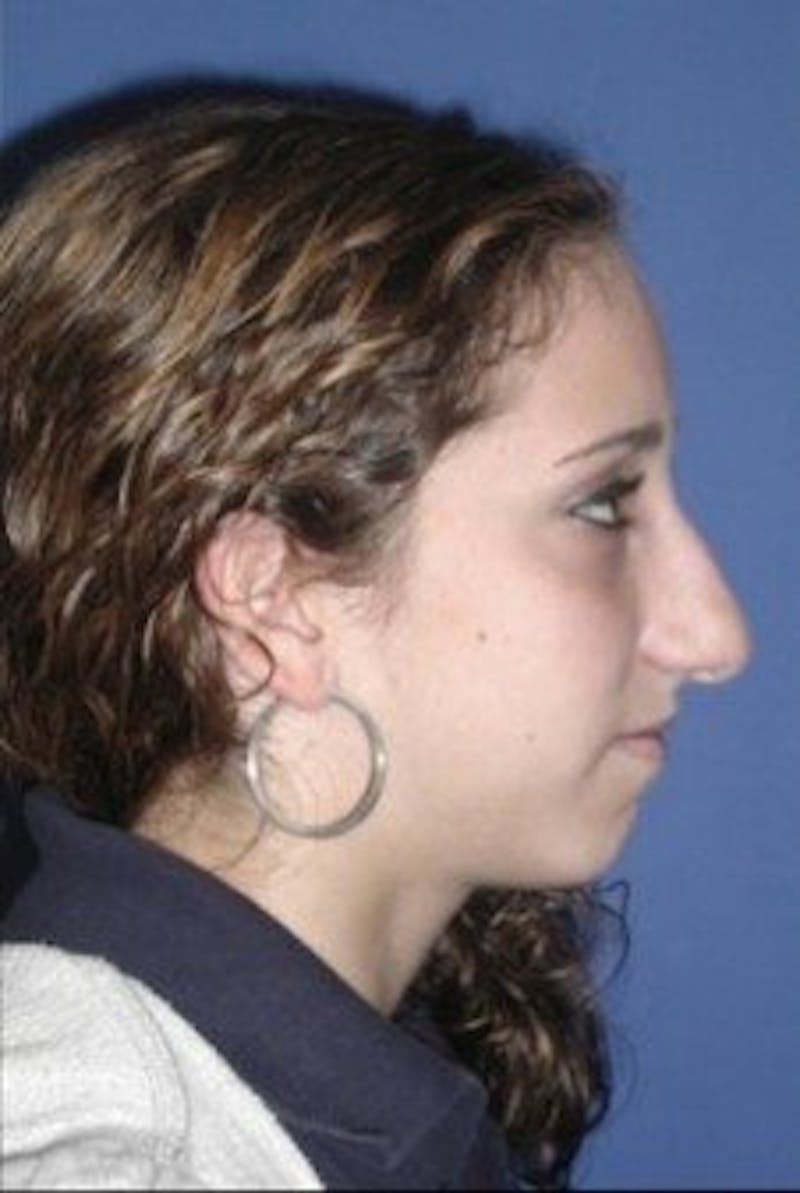 Chin Implant Before & After Gallery - Patient 286367 - Image 3