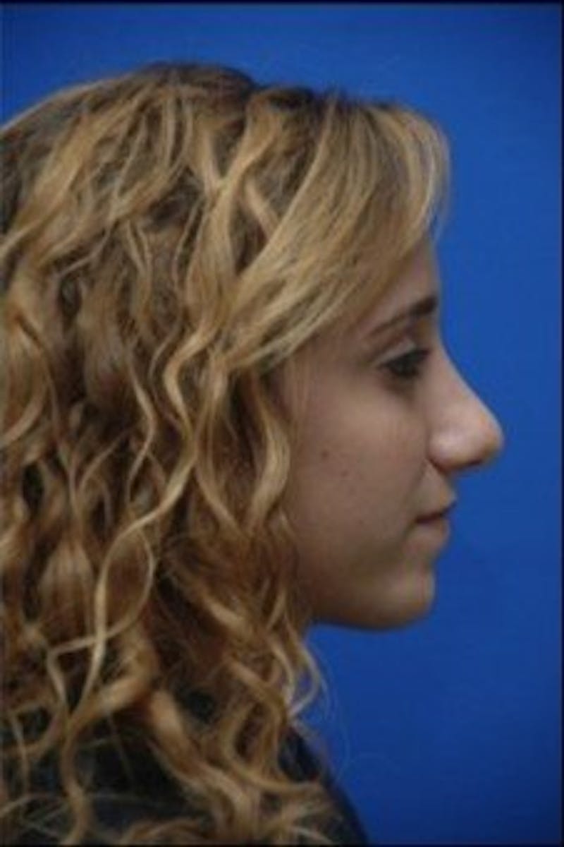 Chin Implant Before & After Gallery - Patient 286367 - Image 4