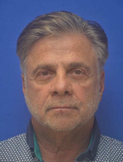 Face Lift Before & After Gallery - Patient 180821 - Image 1
